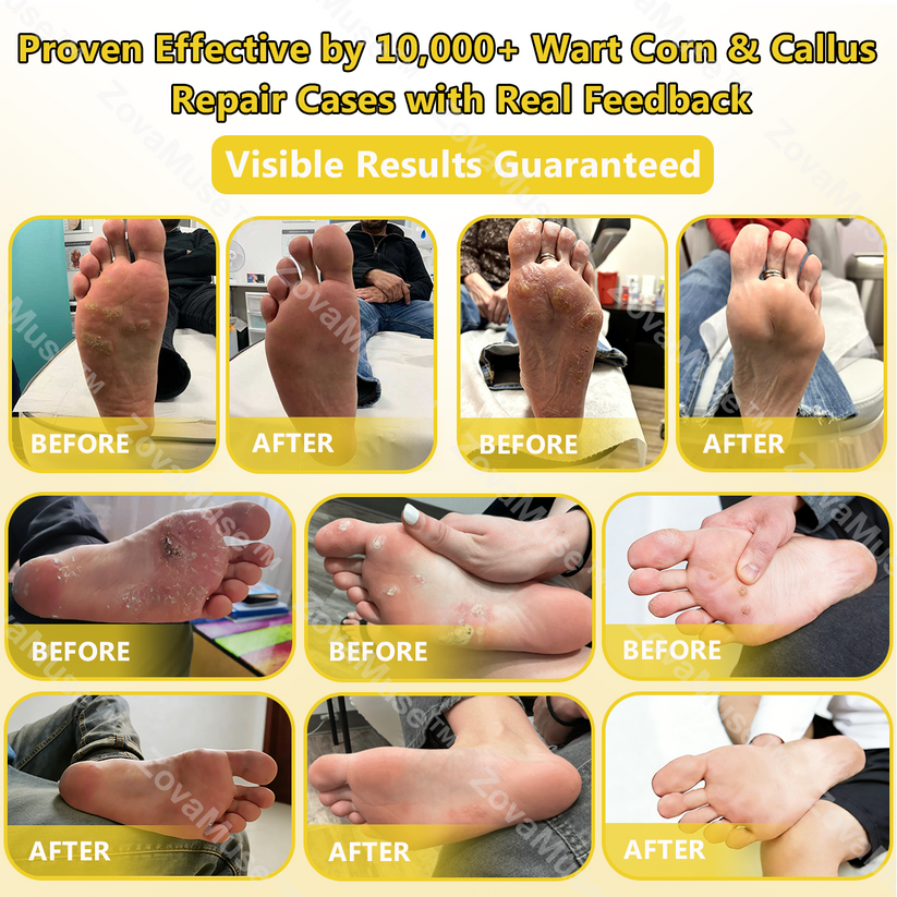 Alcuras® Bee Venom Corn & Callus Remover Cream