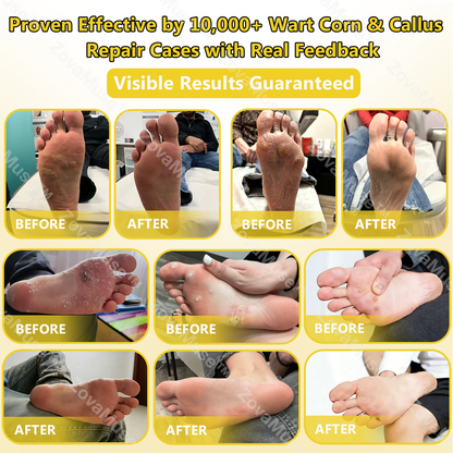 Alcuras® Bee Venom Corn & Callus Remover Cream