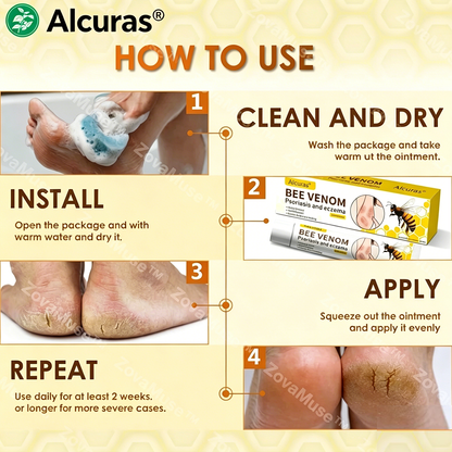Alcuras® Bee Venom Corn & Callus Remover Cream