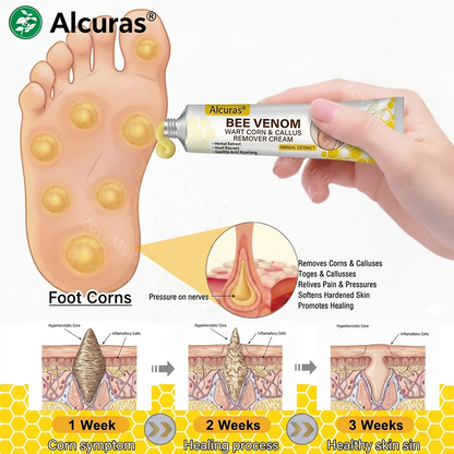 Alcuras® Bee Venom Corn & Callus Remover Cream