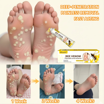 Alcuras® Bee Venom Corn & Callus Remover Cream