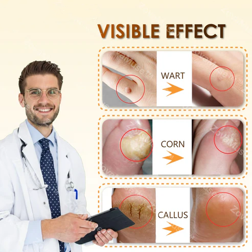 Alcuras® Bee Venom Corn & Callus Remover Cream
